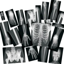Human X-Rays on Film